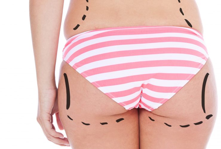 10 Datos Interesantes Sobre La Liposucción 12 Dollarphotoclub 48244291