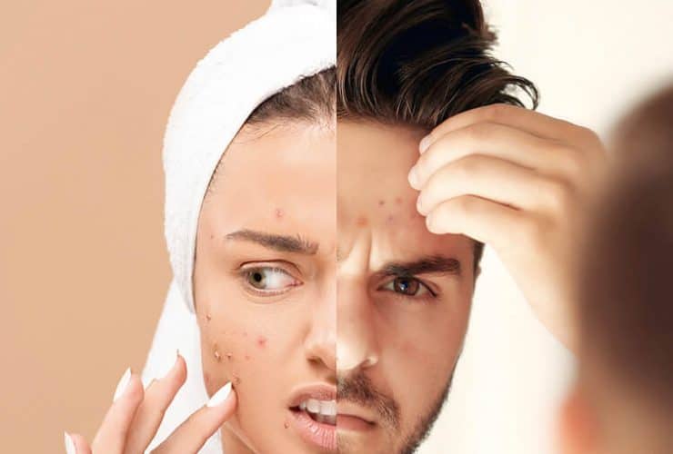 Operación Adiós Acné 57 Acne