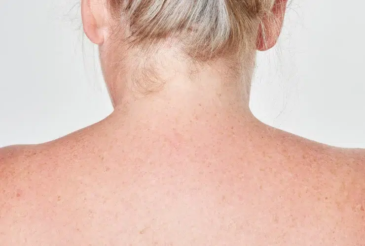 Granitos Causados Por El Sol