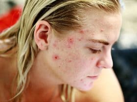 tipos de acné