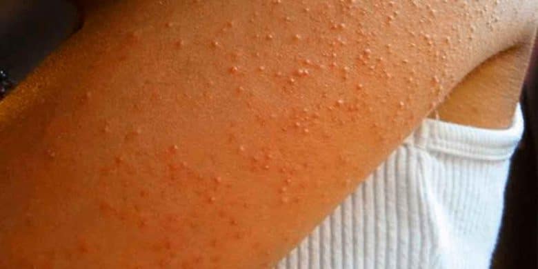 Queratosis Pilaris: causas y tratamientos | Expertos