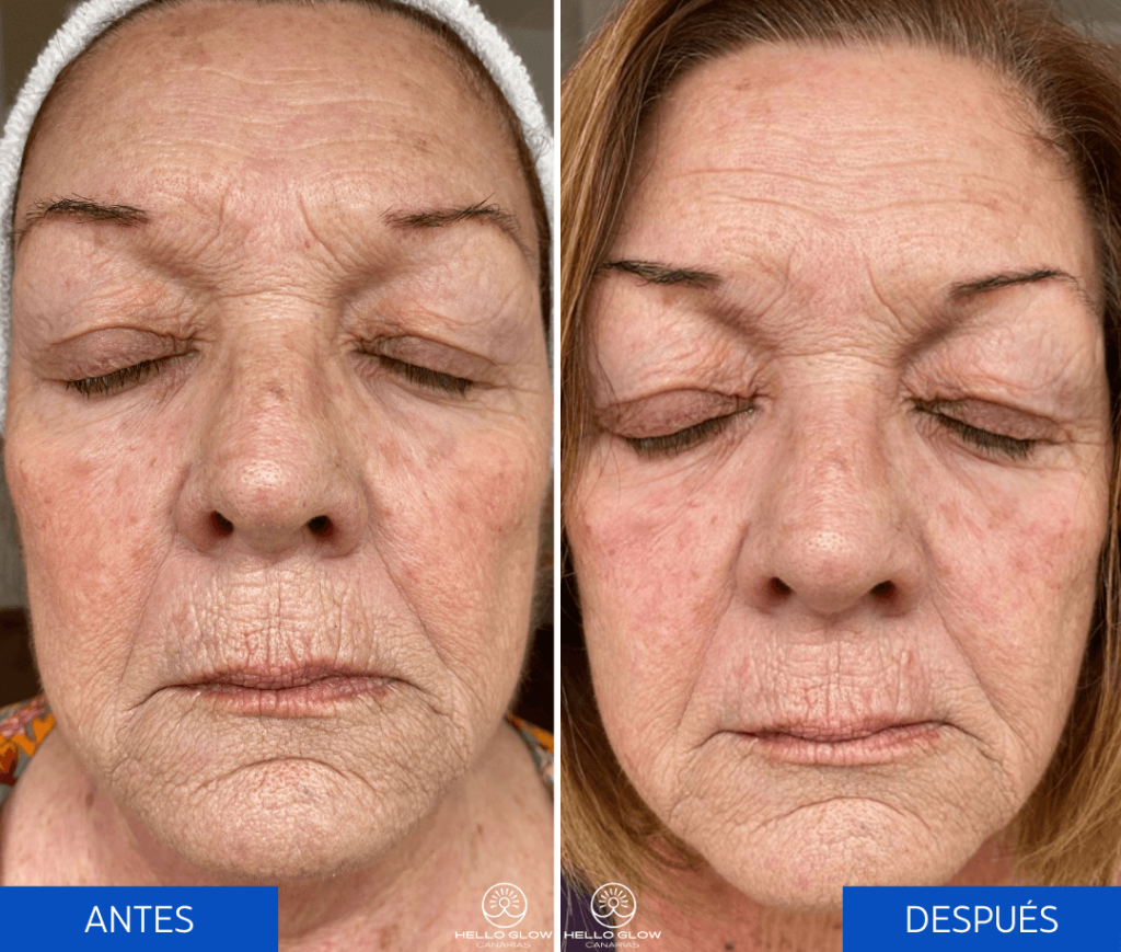 Reafirmación Intensa: La Piel Más Joven Y Tersa Que Nunca 5 Antes Despues1 1
