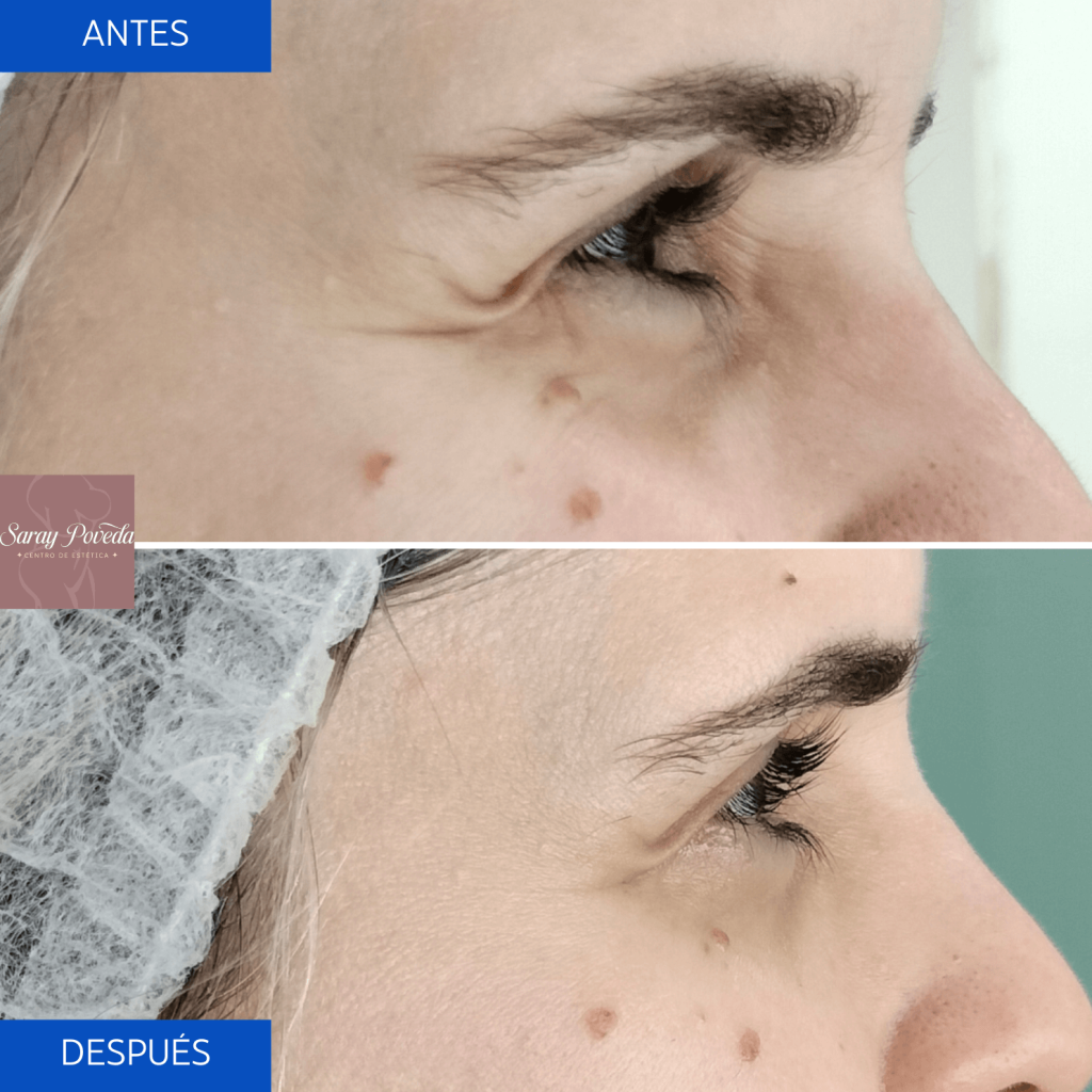 Reafirmación Intensa: La Piel Más Joven Y Tersa Que Nunca 7 Antes Despues3 1