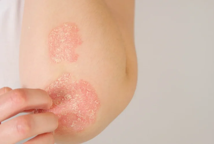Eczema Y Dermatitis