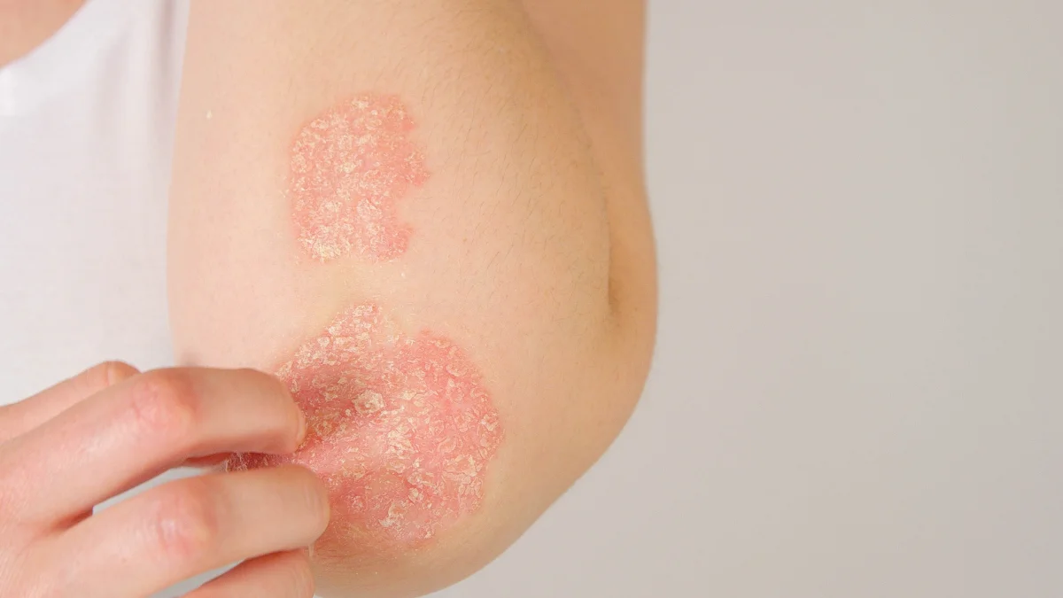 5 Claves Esenciales Para Entender El Eczema O Dermatitis Atópica 1 Eczema Y Dermatitis