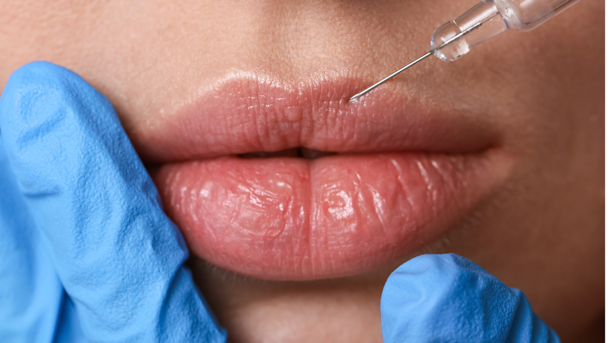 Relleno De Labios: Guía Completa Para Profesionales 1 Relleno En Los Labios Con Acido