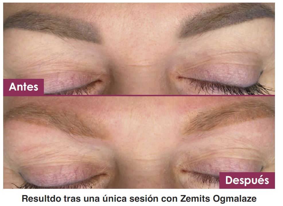 Eliminación De Tatuajes. Beneficios Y Oportunidades De Negocio 2 Eliminacion Tatuajes 3