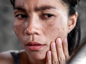 Manchas En El Bigote ¿Qué Tratamiento Es Eficaz? 12 Melasma Bigote