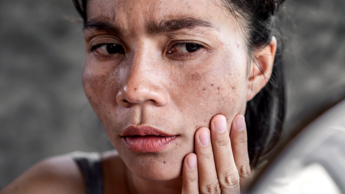 Manchas En El Bigote ¿Qué Tratamiento Es Eficaz? 1 Melasma Bigote